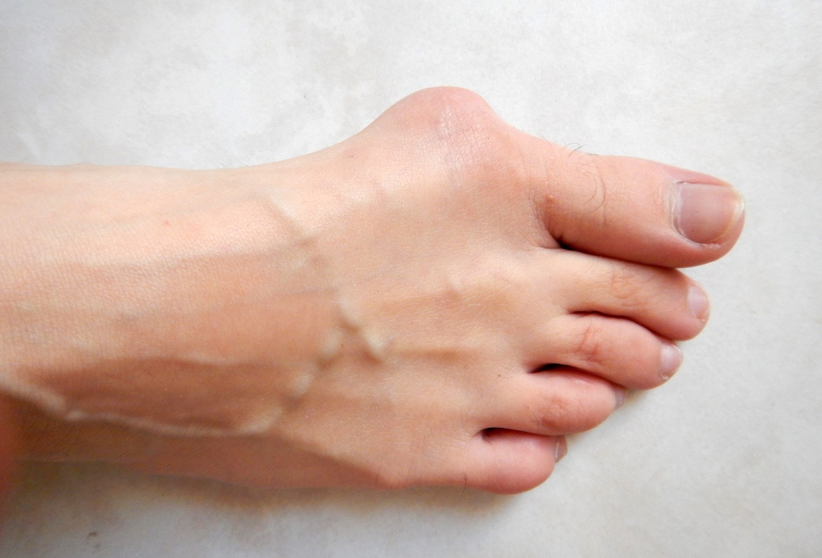 Clinical photo of a foot with a bunion at the base of the big toe