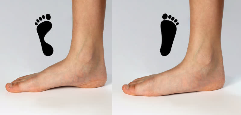 Side by side comparison of a normal arch and a flat foot with footprints